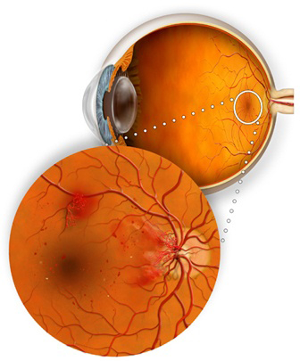 diabetic-retinopathy