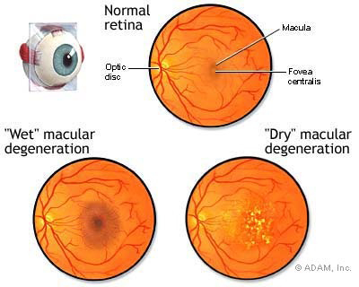 Macular Degeneration