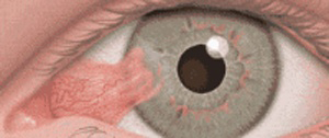 pterygium-img